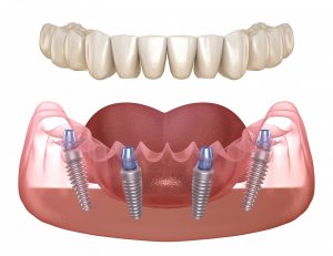 Full Arch Dental Implants illustration with abutments shown